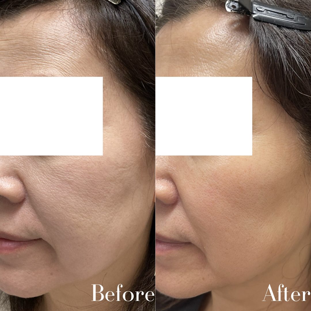 コラーゲンピール症例